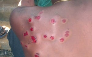 DR.Haiti injuries of construx workers attacked.anonymous